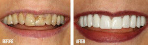 Before and After result tooth colored fillings sacramento