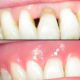 The Essential Guide to Gingival Masks: Procedures, Results & Benefits