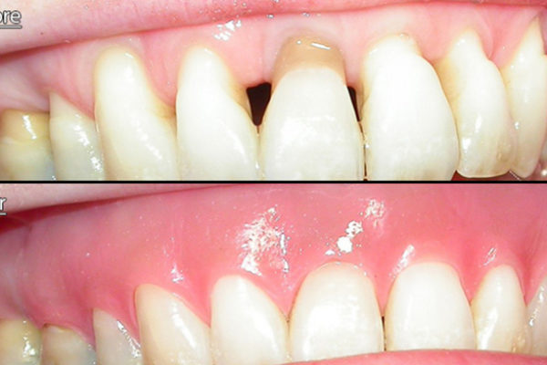 The Essential Guide to Gingival Mask by dr monica crooks