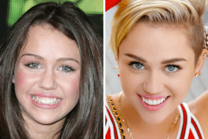 celebrity dental implants before and after 