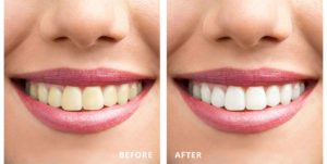 YOUR LOCAL DENTIST TEETH WHITENING SACRAMENTO- Before and after teeth whitening results.