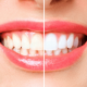 How Can I Fix My Stained Teeth?