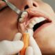Can Teeth Whitening Damage Tooth Enamel?