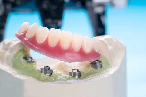 Dental Implant Supported Dentures In Sacramento CA