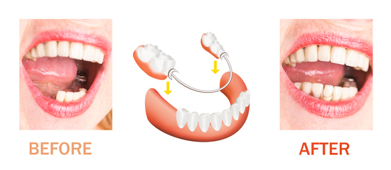 dentures and partials before and after sacramento ca